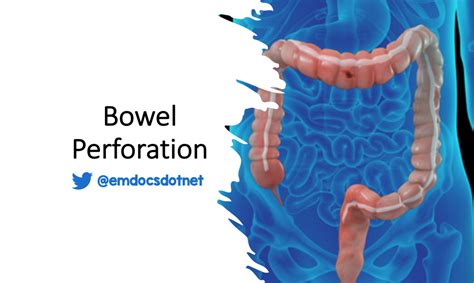 emDOCs.net – Emergency Medicine EducationBowel Perforation: ED ...