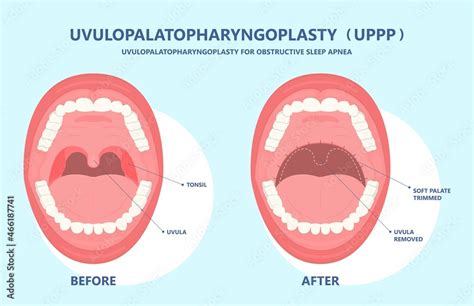 UPPP laser assisted sleep apnea OSA surgery treat tonsil uvula Uvulo ...