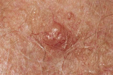 Basal Cell Carcinoma Pictures