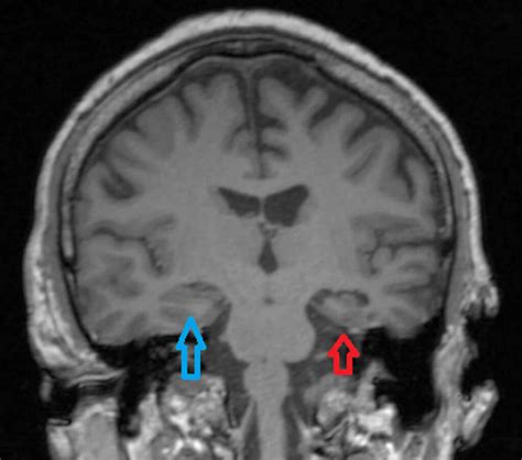 Hippocampal sclerosis causes, symptoms, diagnosis & treatment