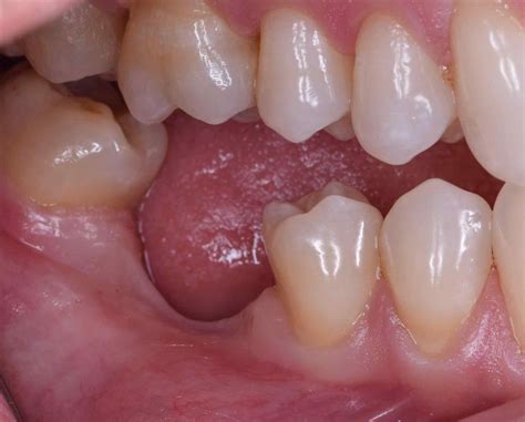 Consequences of early 1st molar extractions? Due to their early ...