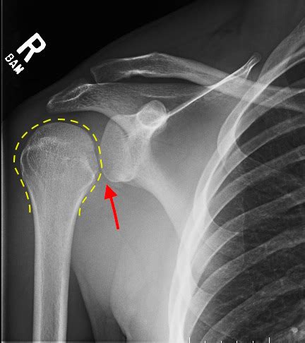 Irreducible Traumatic Posterior Shoulder Dislocation - JETem