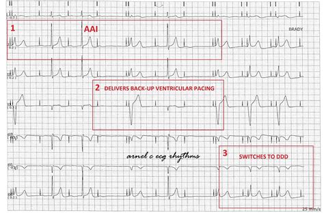 ECG Rhythms: Managed Ventricular Pacing