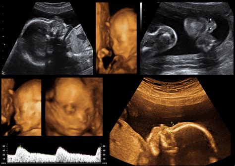 20 Weeks Pregnant 3d Ultrasound