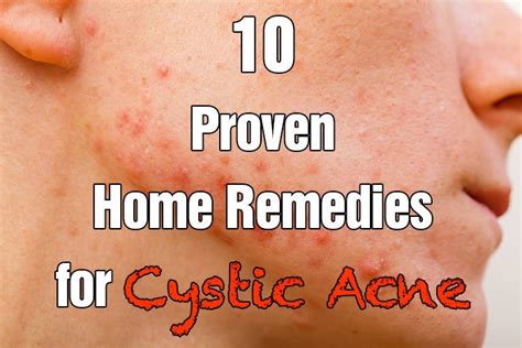 10 Proven Home Remedies for Cystic Acne - Healthy Focus