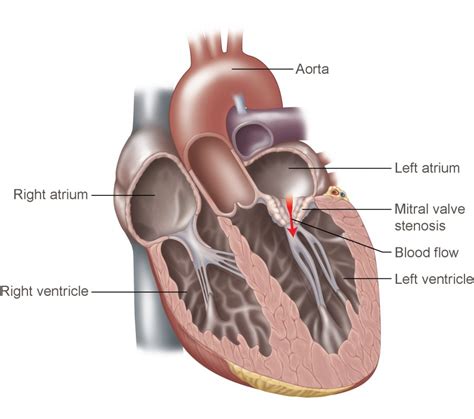 Mitral Valve Stenosis | Temple Health