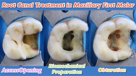 root canal treatment in maxillary first molar 🟢 endostar e3 azure 🟡 ...