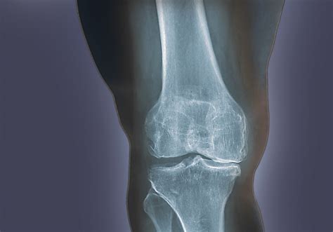 Asymptomatic Hyperuricemia Predictive of Radiographic Knee ...