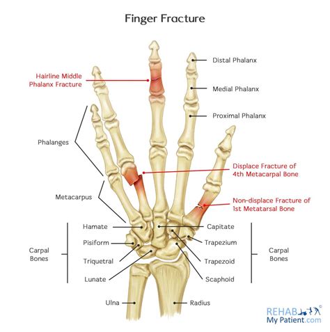 Finger Fracture | Rehab My Patient