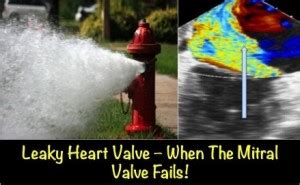 Leaky Heart Valve – When The Mitral Valve Fails