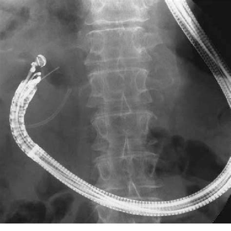 a Choledochoduodenostomy in the duodenal bulb with tube stent (arrow ...