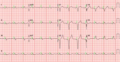 Dr. Smith's ECG Blog: A patient with a ventricular paced rhythm and ...