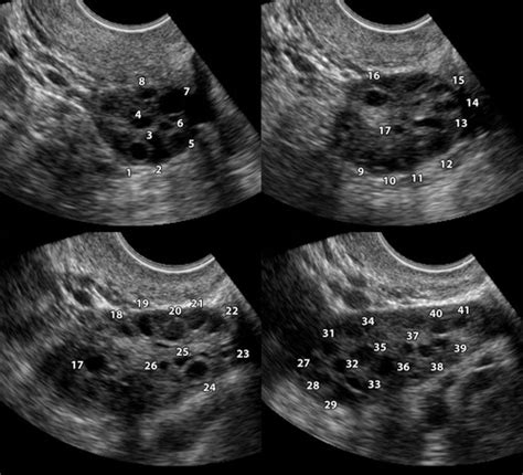 Normal Vs Polycystic Ovaries Ultrasound