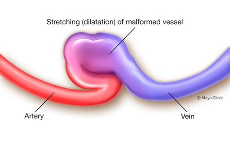 Creating Fistula Dialysis