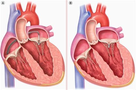 Non Surgical Fix for Leaky Mitral Hear t Valve: