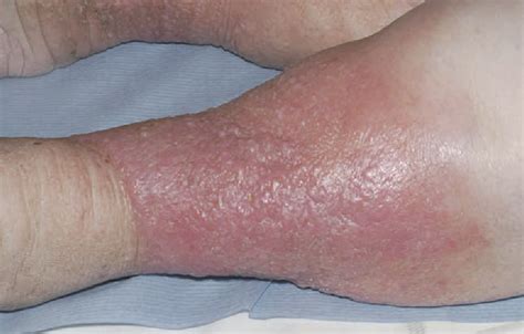 Figure 2 from Chronic peripheral oedema: the critical role of the ...