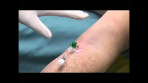 Venflon (intravenous cannula) insertion . Few examples - YouTube