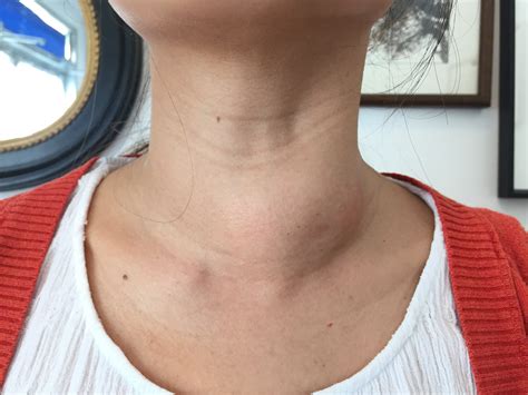 Thyroid Goiters With Nodules 101: – Thyroid Center of Santa Monica