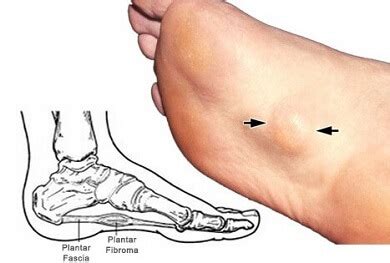 Bump Or Lump On Foot: Causes, Diagnosis & Treatment