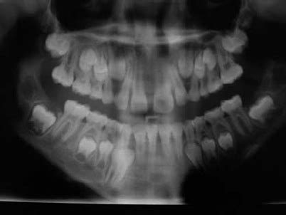 Case 2. Panoramic X-ray view showing taurodontism affecting 2.6 and ...