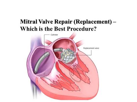 Mitral Valve Repair in Hyderabad | Dr Sarat Explains