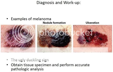 Melanoma: Risk Factors, Diagnosis and Treatment (Infographic) – Virtual ...