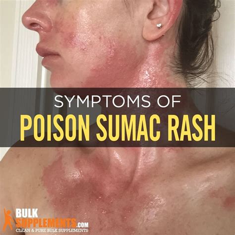 Poison Sumac Rash: Characteristics, Causes & Treatment | Poison sumac ...