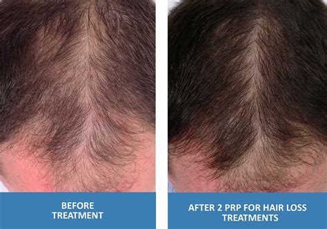 PRP For Hair Loss - Platelet Rich Plasma in Springfield Missouri