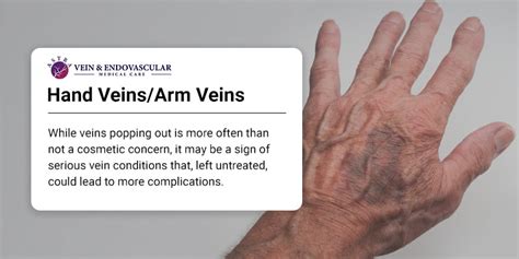 Visible Hand Veins and Why You Have Them? - Vein & Endovascular Medical ...