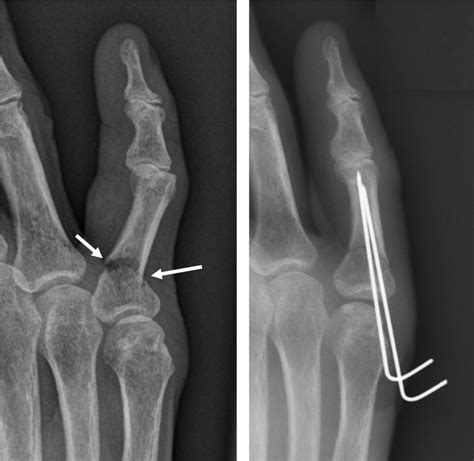 Proximal Phalanx Fracture Hand