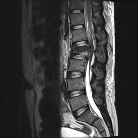 l5-s1 syndrom