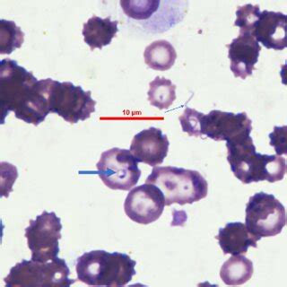 Blood smear from case number 3 on its first admission before treatment ...