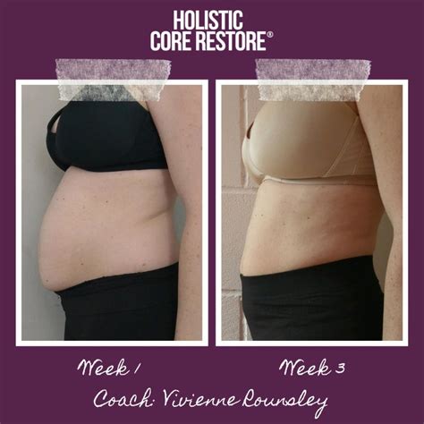 Before & After Diastasis Recti Repair Gallery - Holistic Core Restore