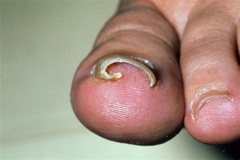 Ingrown toenail - NHS