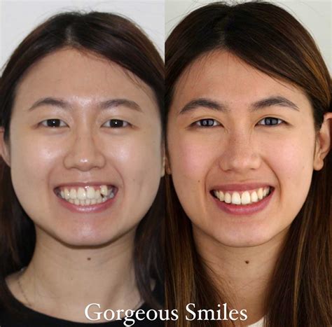 Braces Before And After Pictures - Gorgeous Smiles