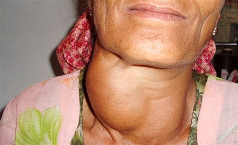 11 Goiter Treatment Without Surgery, Causes and Symptoms | The News God