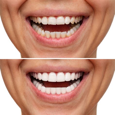 Why Zirconia are the Best Choice: Dental Crowns & Bridges | Manila