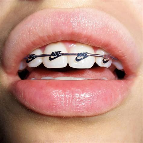 cute braces colors for fall - Holding Weblogs Photographs