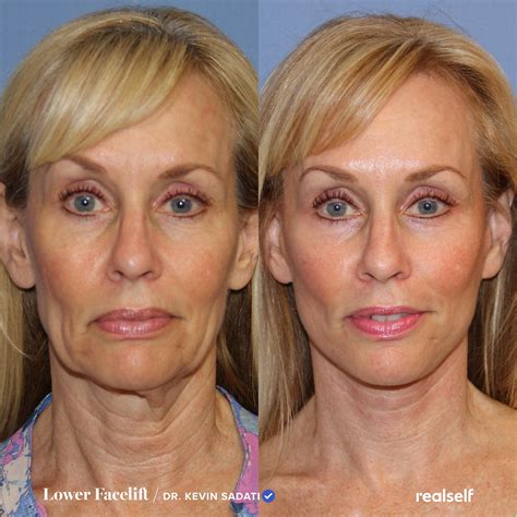 Lower Facelift vs. Neck Lift: What’s the Difference? in 2024 | Lower ...