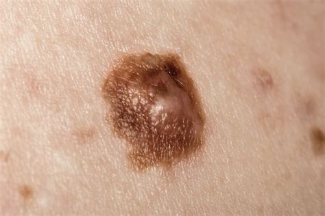 Melanoma Treatment Options at Each Stage