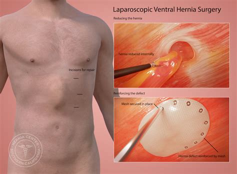 Incisional Hernia Recovery Time