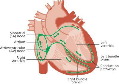 Normal sinus rhythm with ventricular ectopics | Great Ormond Street ...