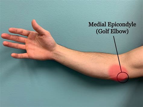 Golfer’s Elbow (Medial Epicondylitis) - Motus Physical Therapy