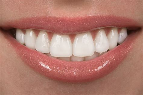 perfect smile veneers