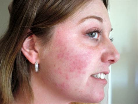 What Causes A Red Itchy Rash On Face - Printable Templates Protal