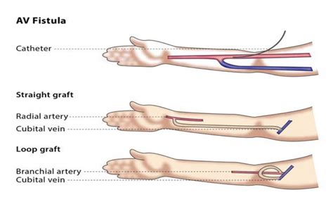 Arterio-Venous Fistula (AVF) creation for Haemodialysis - Cairns ...