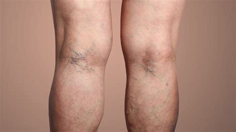 Are Varicose Veins Dangerous? What Are The Symptoms & Treatments ...