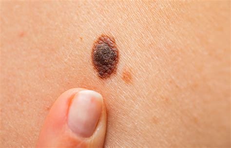 what does a cancerous mole look like | Symptoms and pictures