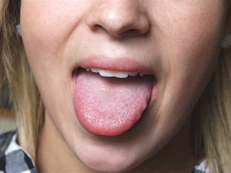 Sore Tongue? 17 Possible Causes - Healthline