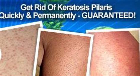 Keratosis Pilaris Before And After